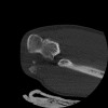 SPORK, NICO - 22.03.1976 - 02.08.2022 - CT obere Extremität - 17:51:17